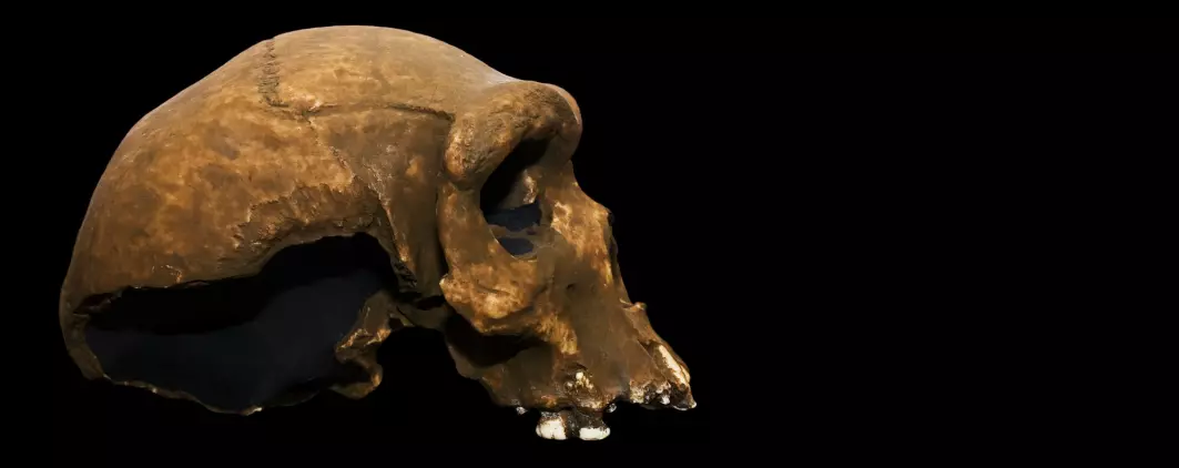 En Homo rhodesiensis-mann er et tidlig eksempel på kraftig kariesangrep. Han levde for omtrent 350.000 år siden.