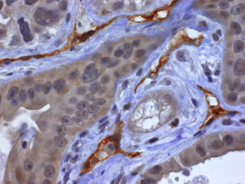 "Bilder viser avstanden mellom kreftcellene (lysebrune) og blodkarene (mørkebrune). Mellom disse ligger bindevevet. Ved å hindre at dette formes kan kreftmedisinen leveres bedre. (Foto: Kenneth Olive)"
