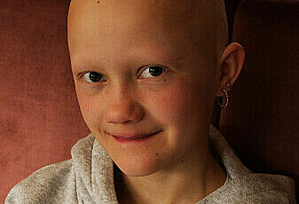 Dette er alopecia