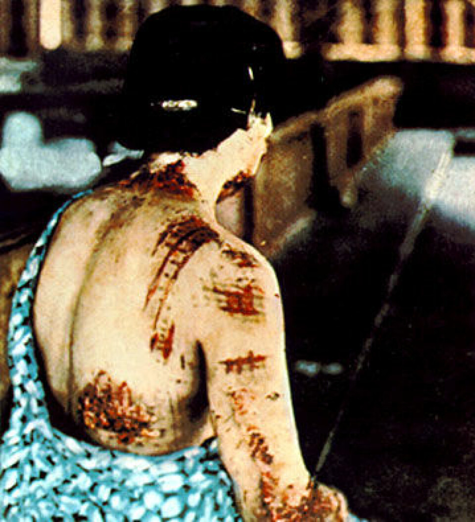 Offer for atombombe, Japan 1945. Pasientens hud er brent etter det mørke mønsteret på kimonoen som ble båret da bomben eksploderte. (Foto: US National Archives)