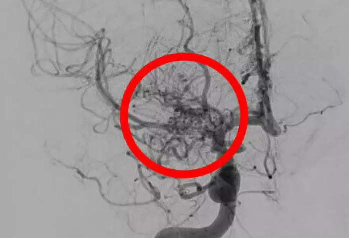 Røntgenbilde (angiogram) av blodkar hos pasient med moyamoya. Den røde ringen markerer et område med unormal oppdeling i mange små blodkar, som ser ut som en røyksky )