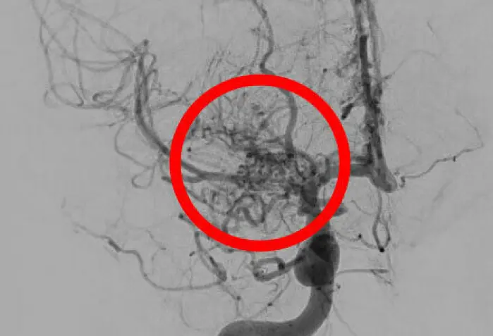 Røntgenbilde (angiogram) av blodkar hos pasient med moyamoya. Den røde ringen markerer et område med unormal oppdeling i mange små blodkar, som ser ut som en røyksky ) Røntgenbilde (angiogram) av blodkar hos pasient med moyamoya. Den røde ringen markerer et område med unormal oppdeling i mange små blodkar, som ser ut som en røyksky )