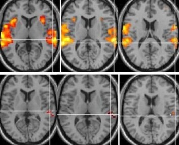 Nevronal aktivering i hjernen hos ikke-hallusinerende pasienter (øverst), og hos hallusinerende pasienter (nederst). (Foto: fMRI-gruppen Bergen) Nevronal aktivering i hjernen hos ikke-hallusinerende pasienter (øverst), og hos hallusinerende pasienter (nederst). (Foto: fMRI-gruppen Bergen)