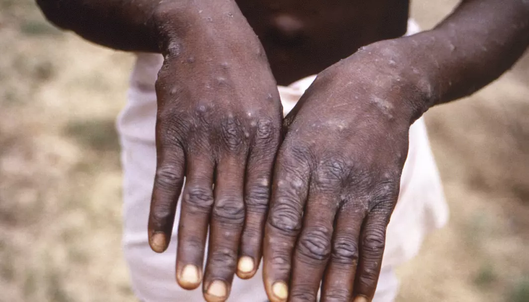 En kongolesisk mann viser fram hendene sine etter å ha blitt smittet av apekopper i 1997. I Afrika har det vært jevnlige utbrudd av sykdommen i flere tiår, men først nå, etter noen hundre tilfeller i vestlige land, har forskningen på sykdommen skutt fart.