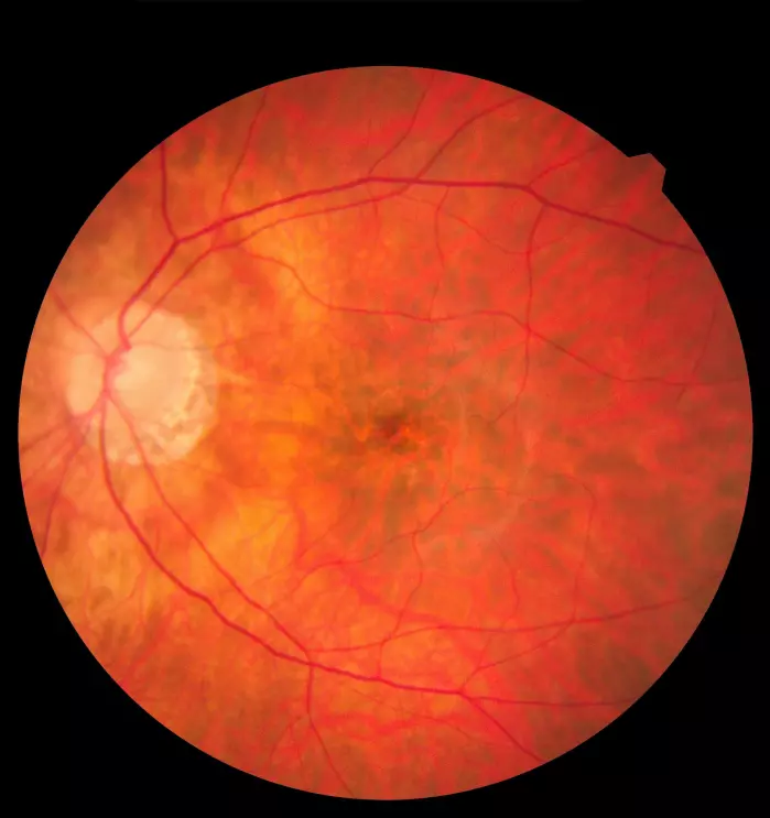 Dette er et bilde av netthinnen, øyeeplets indre overflate. Fagpersoner kan avdekke risiko for en rekke sykdommer ved å studere hvordan den ser ut.
