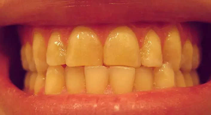 Det kan få uheldige konsekvenser når skjærer tenner. Forskere har nå observert at det framkaller stor hjerneaktivitet i våken tilstand og håper den nye kunnskapen kan brukes til hjelpe folk med den dårlige vanen. (Foto: Wikimedia Commons)