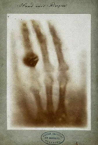 Verdens første røntgenbilde. Bildet viser hånda til Wilhelm Röntgens kone.