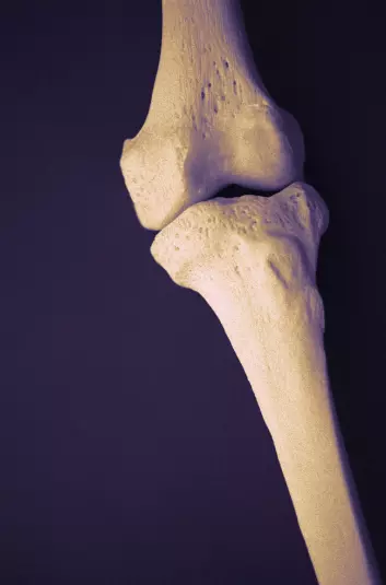 "Hver tredje kvinne i Norge over 50 år utvikler osteoporose (beinskjørhet). Menn har i utgangspunktet kraftigere beinstruktur og blir ikke rammet av osteoporose i like stor grad som kvinner. Illustrasjonsfoto."