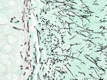 "Det viste seg at 47-åringen hadde pådratt seg aspergillose. Sopptråder (mycel) hadde begynt å vokse i lungene hans. Dette bildet er fra en obduksjon av en annen pasient med aspergillose. Foto: Wikimedia Commons."