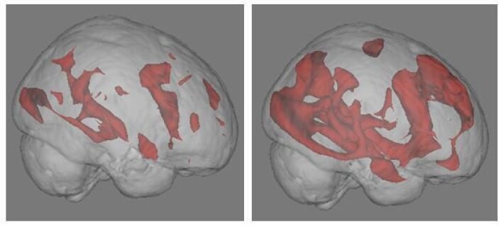 Resultatene kommer til syne ved hjelp av hjerneskanning med FMRI. Bildet til høyre viser hvordan nettsøk setter store nervekretser i arbeid. Til venstre ser vi at hjerneaktiviteten er lavere mens en person leser en bok. Foto: University of California. Resultatene kommer til syne ved hjelp av hjerneskanning med FMRI. Bildet til høyre viser hvordan nettsøk setter store nervekretser i arbeid. Til venstre ser vi at hjerneaktiviteten er lavere mens en person leser en bok. Foto: University of California.