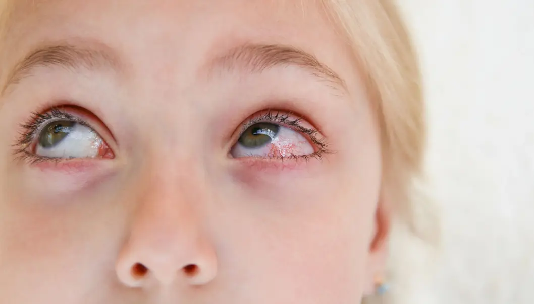 Tørrhet i øyne og munn kan ha flere årsaker, forklarer Håvard Hynne. Det kan skyldes bruk av medisiner eller være en bivirkning av kreftbehandling. Tørrhet i øyne og munn kan ha flere årsaker, forklarer Håvard Hynne. Det kan skyldes bruk av medisiner eller være en bivirkning av kreftbehandling.
