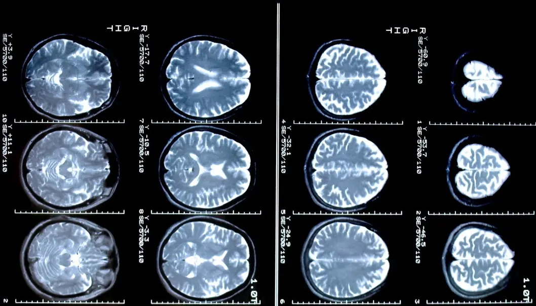 I en liten studie ble syv menn med Downs syndrom gitt et hormonregulerende preparat. Forskerne undersøkte effekten gjennom tester og MR-scanning. I en liten studie ble syv menn med Downs syndrom gitt et hormonregulerende preparat. Forskerne undersøkte effekten gjennom tester og MR-scanning.