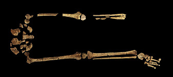 Gutt fikk amputert beinet for 31.000 år siden