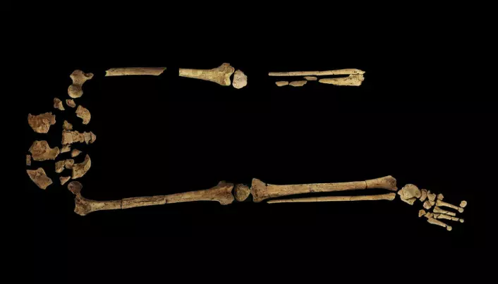Gutt fikk amputert beinet for 31.000 år siden
