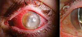 Ny behandling kan redde synet til de som får alvorlig infeksjon i øyet