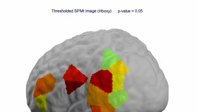 Bildet viser scanning av hjernen mens personen lyttet til språklyder. Det viser at språkprosessering involverer flere hjerneområder, spesielt i venstre hjernehalvdel.