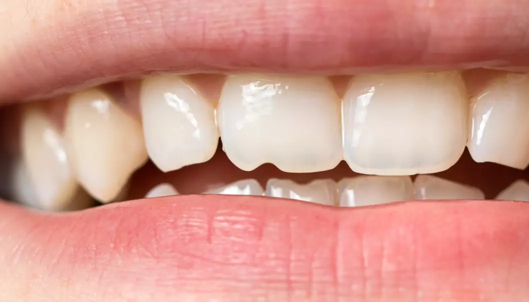 Skader på emaljen er svært vanlig å pådra seg gjennom livet. Større skader kan svekke tannen betydelig.
