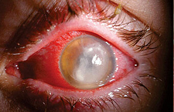 A new treatment can save the eyesight of those who get a serious eye infection