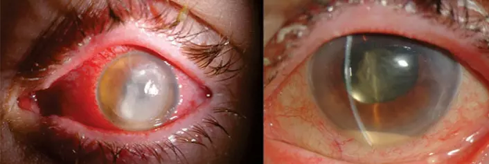 The images show eyes with endophthalmitis, a serious infection in the eye. Endophthalmitis is the most feared complication by ophthalmologists. In the worst case, the infection can cause blindness.