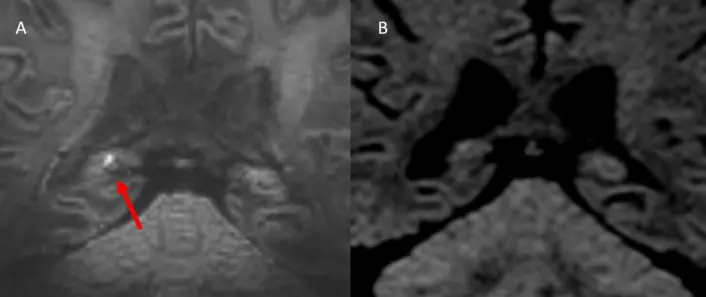 The same brain imaged with two different MRI machines. In photo A on the left, a change in the memory centre is shown as a white dot. Photo B on the right, which was taken with a regular MRI machine, does not show the same change.