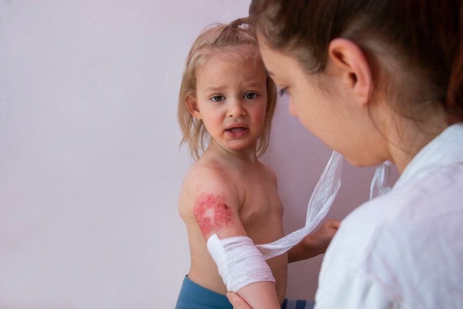 På sykehuset får barnet gjerne mere smertestillende ved skifting av bandasjer, mens slik er det ikke hjemme. Enkelte må dermed nesten gå i krig med barnet fordi dette er så smertefullt.
