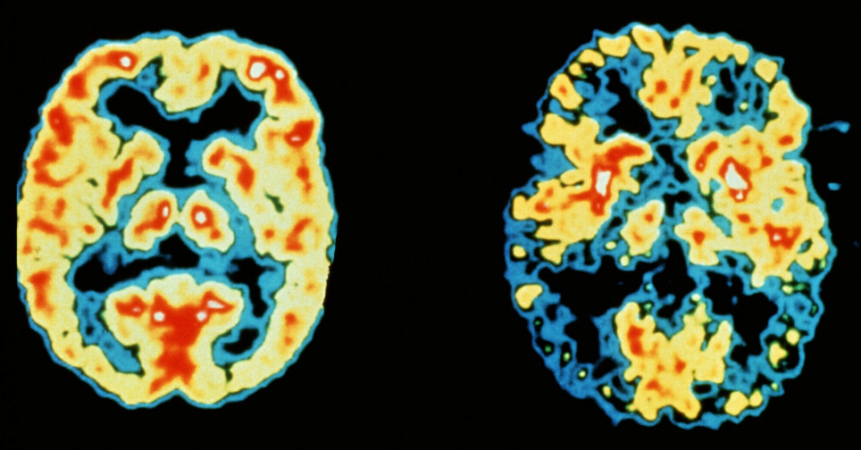 Bilder tatt med PET-skanner gjør det nå mulig å se forskjellen på hjernen til en normal person (venstre) og en Alzheimer-pasient.
