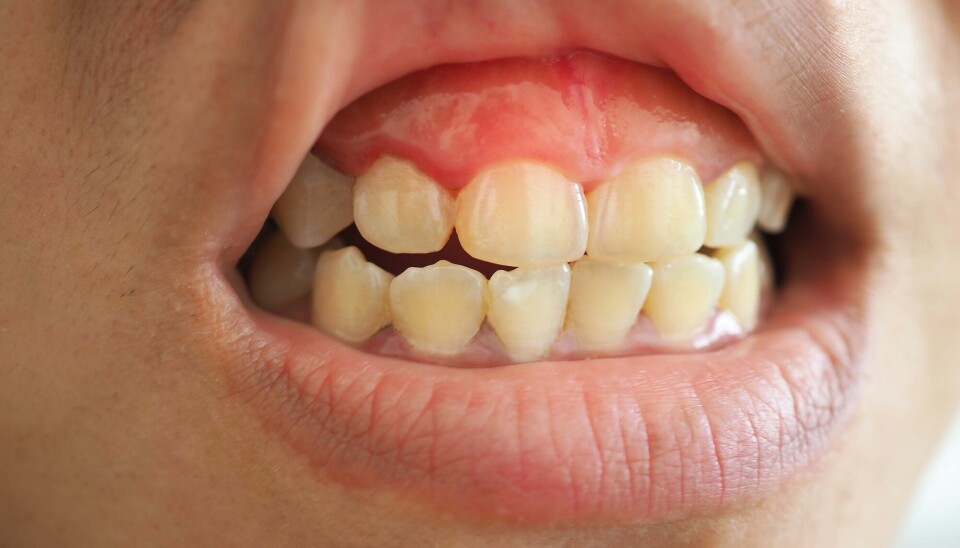 Bildet viser tannkjøttbetennelse, gingivitt, hos en kvinne. Bakterier som forårsaker alvorlige betennelser i munnen, kan havne andre steder i kroppen.
