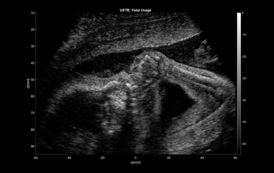 Et ultralydbilde av et foster hvor ultralydsignalene er tatt opp på et GE Voluson Women's Healh Ultrasound system. Bildet er behandlet med the UltraSound ToolBox.