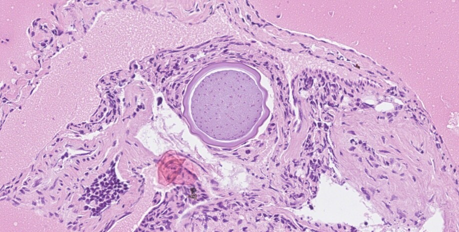 Vevssnitt fra pukkellaks med en sopplignende parasittstruktur som er forenlig med Ichthyophonus sp. i tarmveggen.