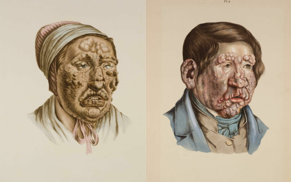 Illustrasjoner til Daniel Cornelius Danielssen og Carl Wilhelm Boecks monografi Om Spedalskhed utgitt i 1847.