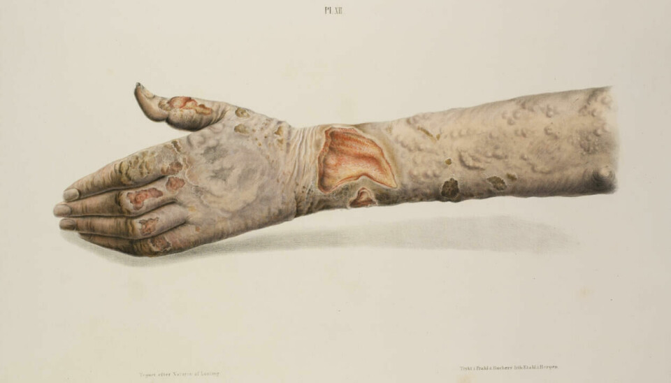 Illustrasjon av armen til en leprasyk, fra boka Om Spedalskhed fra 1847.