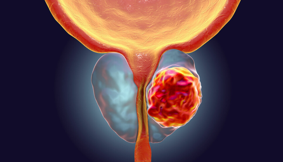 Bildet viser en 3D-illustrasjon som viser en svulst inne i prostata som presser på urinrøret.