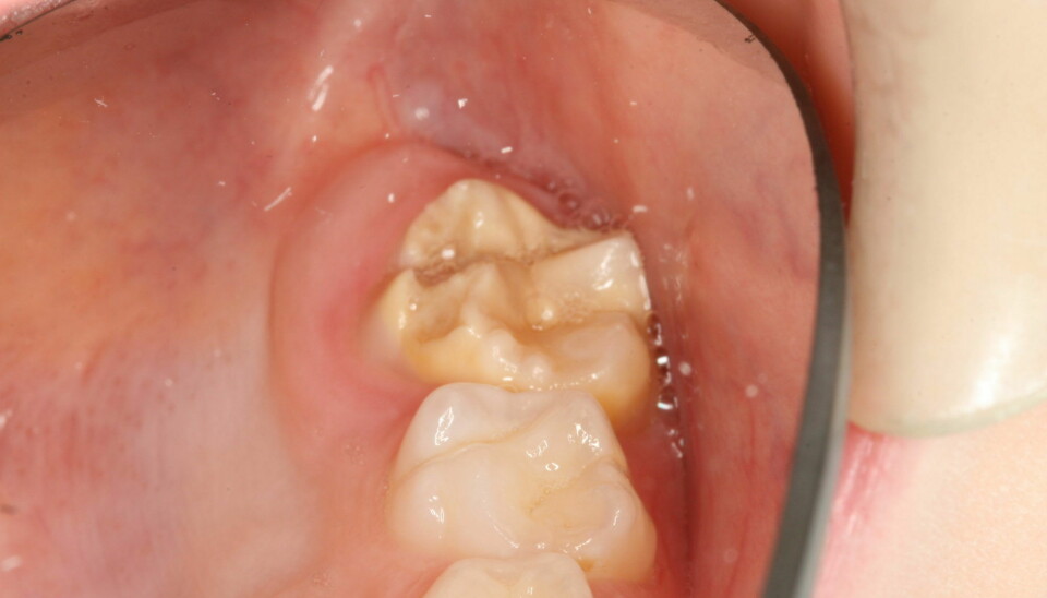 This is what a severely impacted molar looks like. It is a child’s completely new adult tooth. The molar develops a yellowish brown colour. Two pieces have already fallen off, which appear as two craters to the left of the crown. A healthy tooth with no enamel defects next to it is completely white.