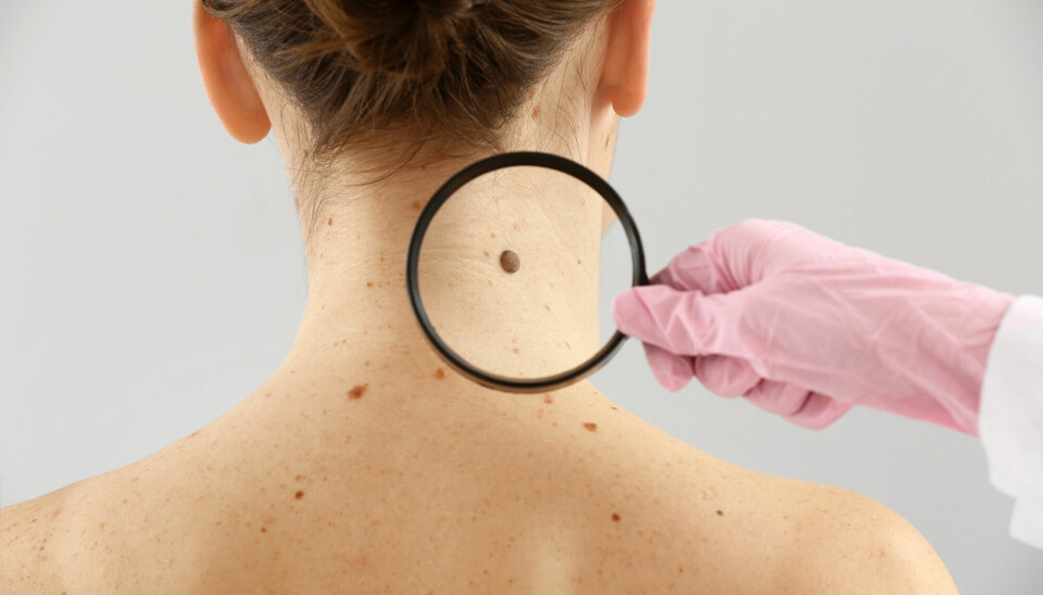 Forekomsten av melanom øker - også kjent som føflekkreft.