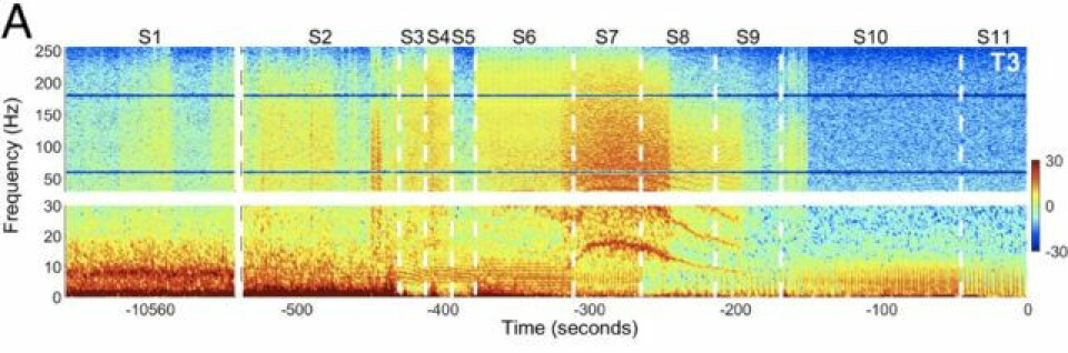 Illustrasjon fra studien som viser den plutselige bølgen av gammaaktivitet. Aktiviteten ble målt med en såkalt EEG-skanning som registrerer hjernens elektriske impulser.