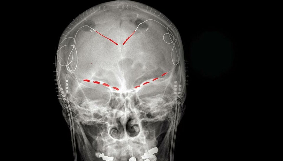 Fire pasienter med kroniske smerter fikk operert inn elektroder i hjernen som målte hjerneaktivitet.