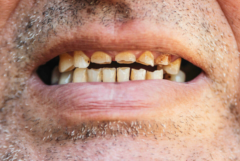 Nærbilde av ansikt til mann, der vi ser munn med dårlige tenner.