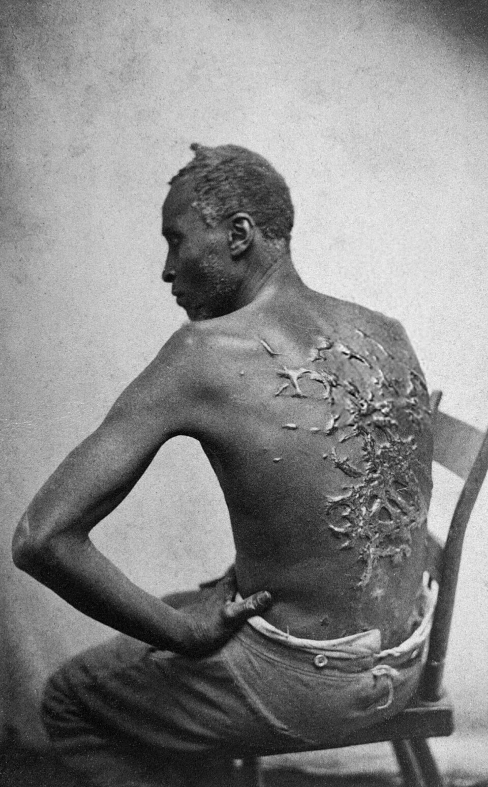 Bildet fra 1863 viser en slave som har klart å rømme til Nordstatene. Ryggen er full av arr etter pisking - altså behandlingen legen Samuel A. Cartwright anbefalte for å forebygge den psykiske sykdommen drapetomani - eller rømmesyke.