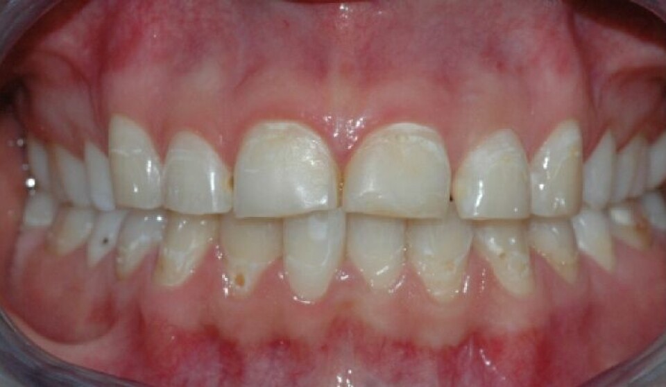 Eksempel på syreskader, hvor man ser misfarging på tennene, groper hvor emaljen har etset bort, og matte områder.