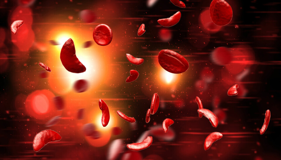 Ved sigdcelleanemi blir de røde blodcellene på sikt deformerte og avlange istedenfor runde. Formen ligner en sigd, derav navnet.