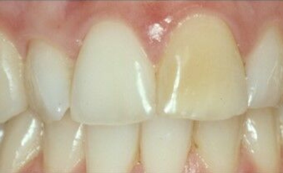 Spesielle skader på en tann kan blekes.