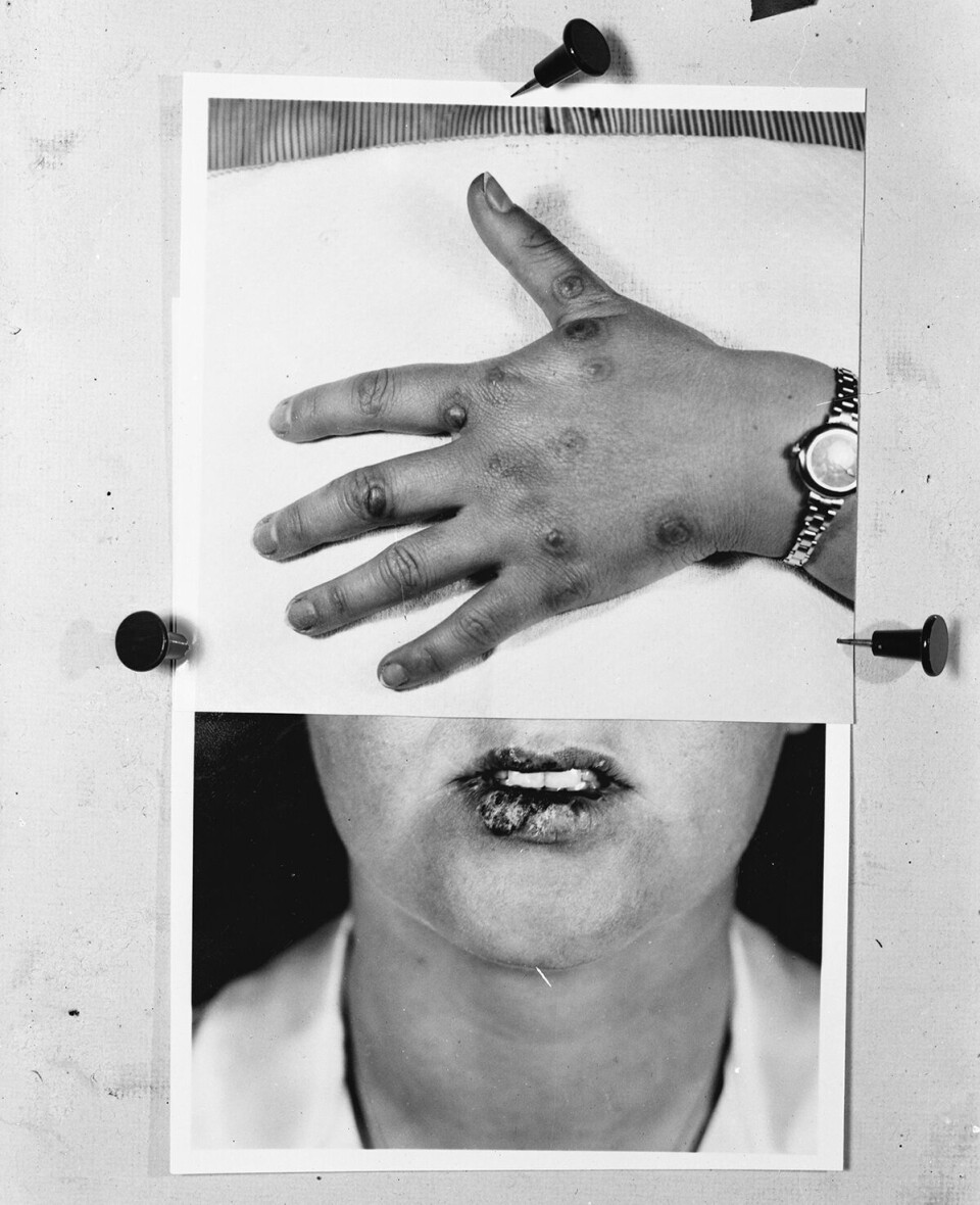 To bilder avfotografert sammen til undervisning i 1939. Pasient med herpes simplex hudinfeksjon på leppene og erythema multiforme forårsaket av infeksjonen på hendene. Erythema multiforme etter herpesvirusinfeksjon gir ofte disse karakteristiske 'bulls eye'-utslettene.