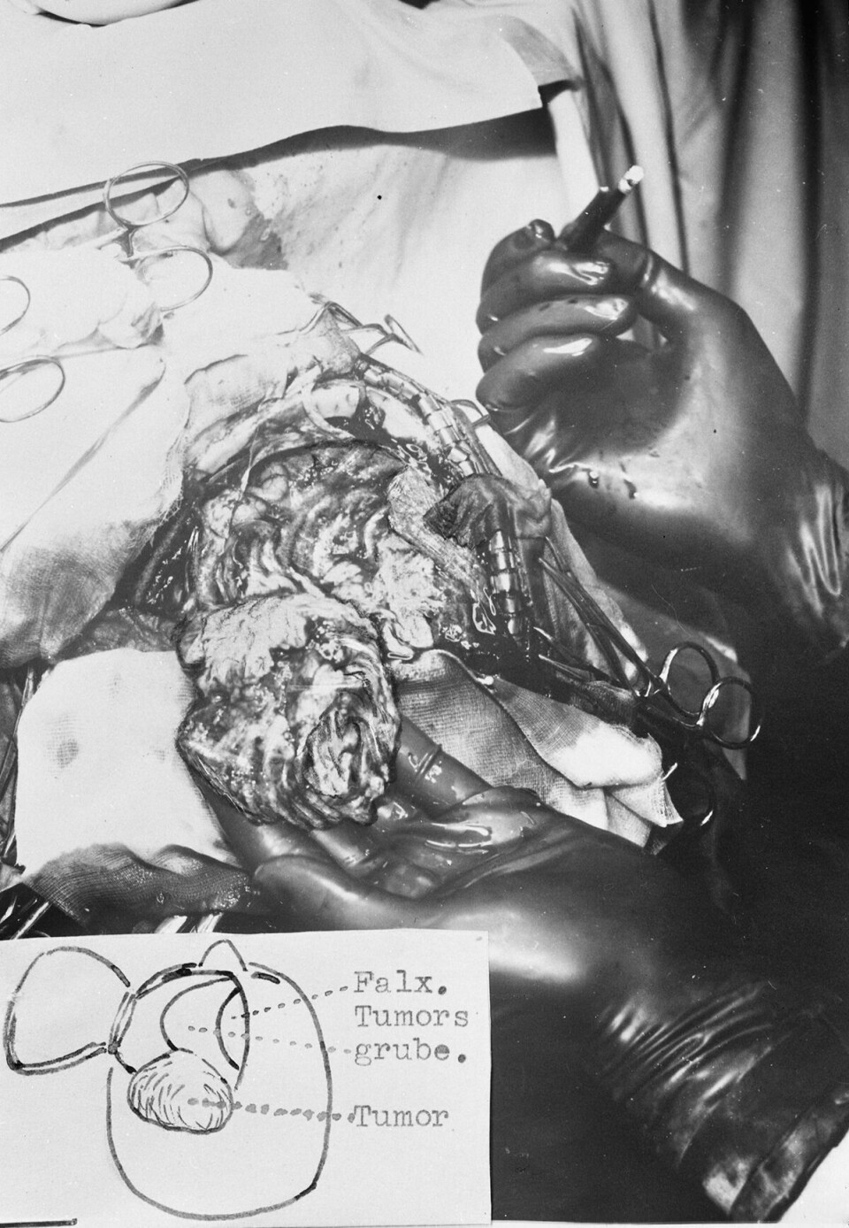 Foto med anmerkninger fra desember 1938 som viser kirurgisk fjerning av en hjernesvulst fra en 42 år gammel kvinne. Bildene er tatt for Rikshospitalets Nerveavdeling, som det het den gang. «Tumors grube» er det vi i dag ville kalt tumorkaviteten. «Falx.» er falx cerebri, eller sigdfolden, en fold av dura mater som går ned mellom de to hjernehalvdelene. Vi vet ikke hvem operatøren var eller hvordan det gikk med pasienten. Dette er altså før antibiotika ble tatt i bruk, og mulighetene til behandling av postoperative infeksjoner var færre enn i dag.