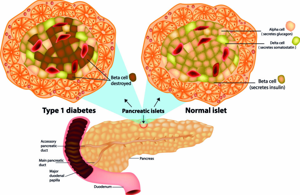 In the pancreas, or the pancreatic gland, you’ll find the islets of Langerhans (Pancreatic islets), which house beta cells. These cells produce insulin, which is released into the bloodstream as needed. Type 1 diabetes mellitus is an autoimmune disease where the body’s immune system destroys the beta cells. Consequently, the gland either ceases to produce insulin altogether or produces insufficient amounts.