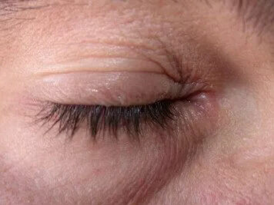 Et eksempel på mild allergisk kontakteksem på øyelokkene etter påføring av et kosmetisk produkt.