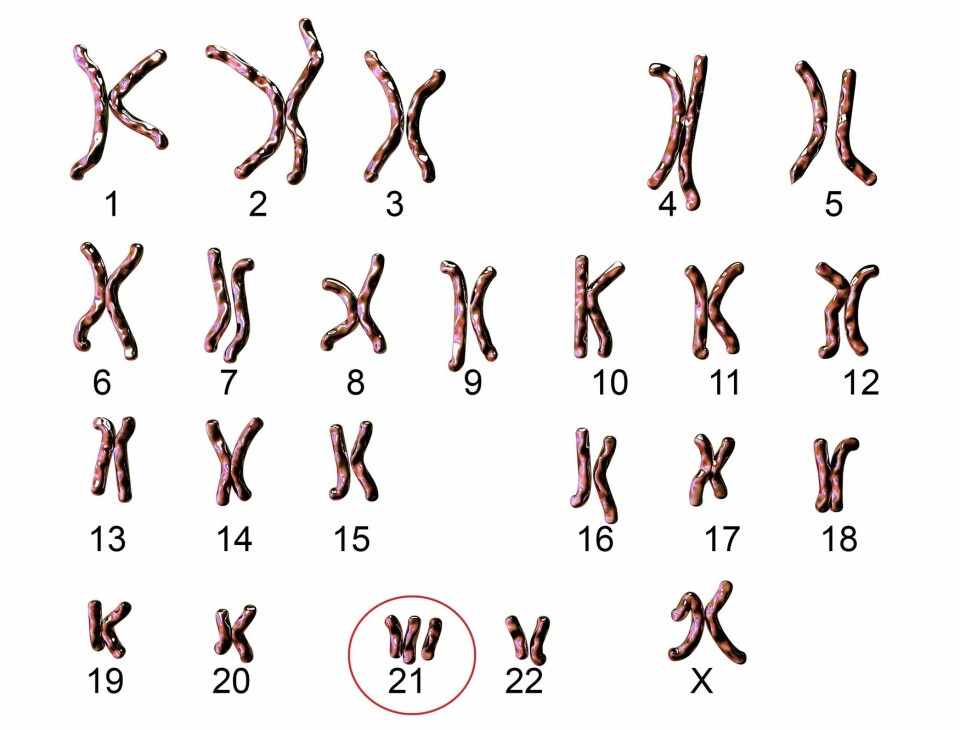 Kromosomene til en som har Downs syndrom, slik de kan se ut under et mikroskop. Rød ring rundt kromosom 21, som det finnes tre stykker av. Resten av kromosomene finne det bare to stykker av.