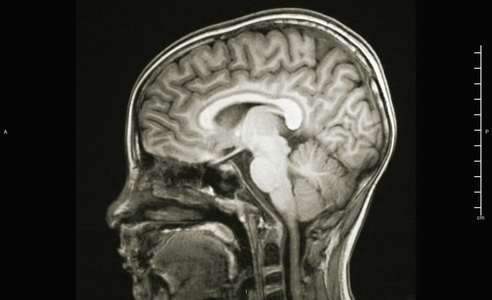 Et MR-bilde av et hode. Hjernen har lysere farge og aller lysest er det innerst i hjernen og i et omriss rundt hjernen.