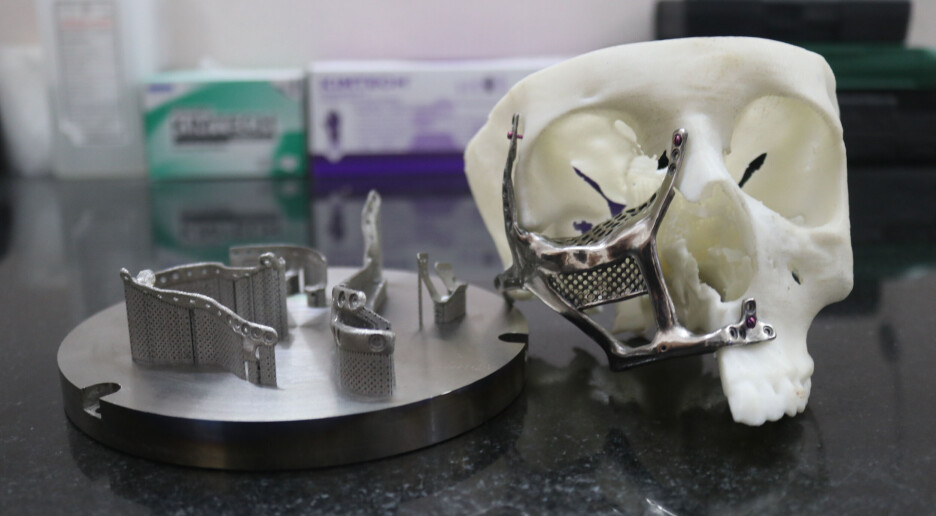 Soppinfeksjonen spiser opp ansiktet. Kan 3D-printing være til hjelp?