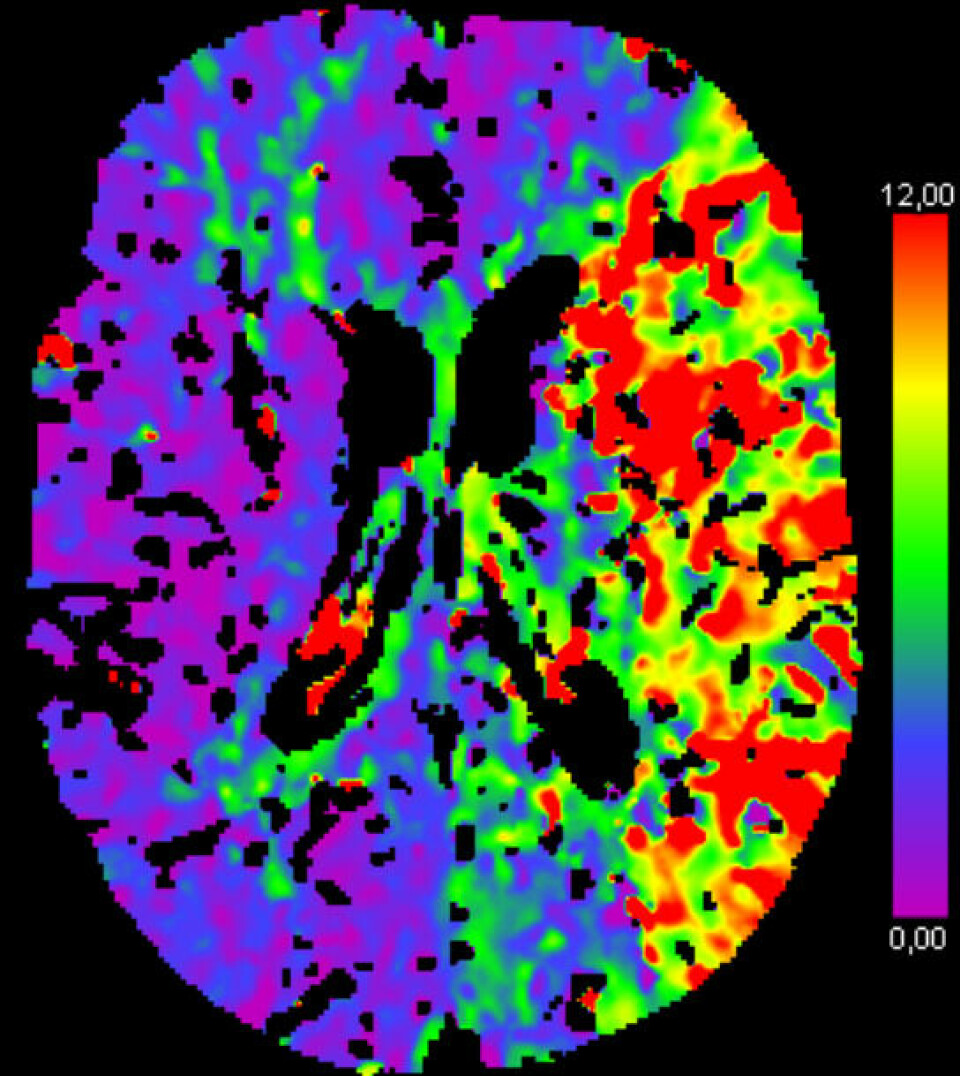CT-bilde av hjerne