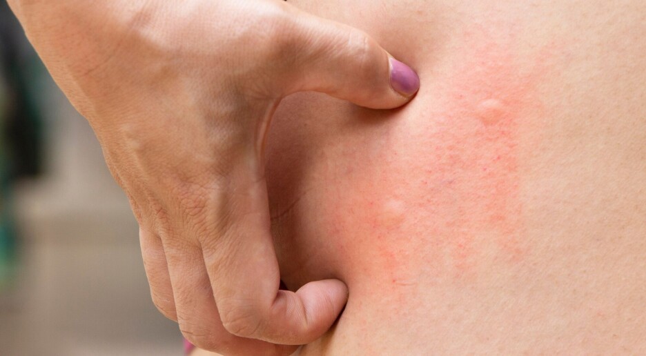 Dette trikset får myggestikket til å slutte å klø på sekunder